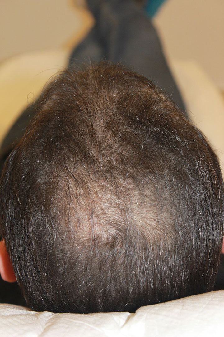 I-PRF therapy against hair loss - Hairhungary Clinic