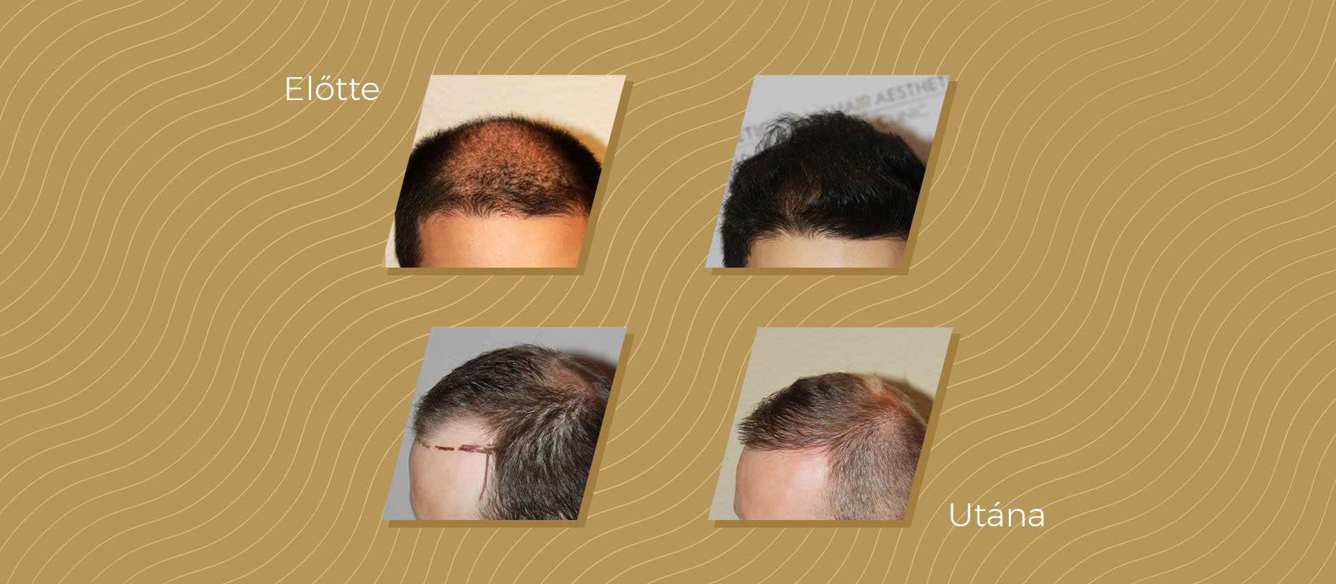 Regenerative therapy against hair loss